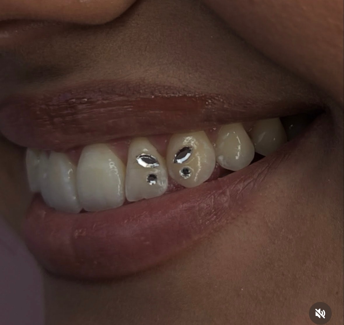 Tooth gem placement